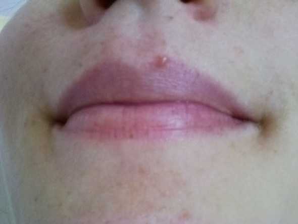Hallo Ich Habe Seit Jahren Eine Seltsame Blase Auf Der Oberlippe Es Ist Kein Herpes Da Nun Seit 10 Jahren Dauerhaft Und Auch Keine Talgdruse Was Ist Das Lippe Hallo Ich Habe Seit Jahren Eine Seltsame Blase Auf Der Oberlippe Es Ist Kein Herpes Da Nun Seit 10 Jahren Dauerhaft Und Auch Keine Talgdruse Was Ist Das Lippe