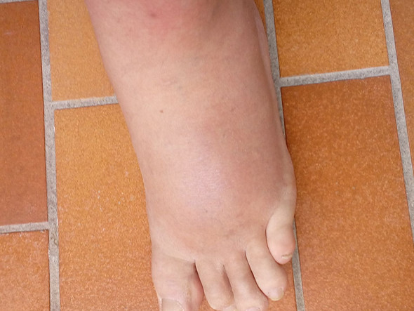 Hallo Konnt Ihr Mir Helfen Oder Sagen Warum Mein Fuss So Extrem Geschwollen Ist Gesundheit Arzt Krankheit Hallo Konnt Ihr Mir Helfen Oder Sagen Warum Mein Fuss So Extrem Geschwollen Ist Gesundheit Arzt Krankheit