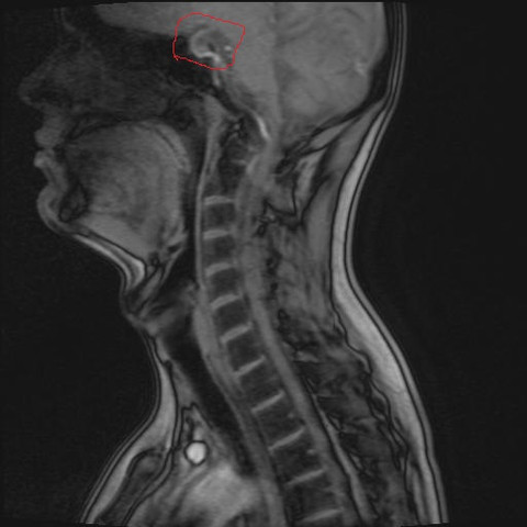 Hallo Vor Kurzem Wurde Ein Mrt Von Meiner Wirbelsaule Angefertigt Dann Habe Ich So Etwas Komisches Gefunden Ist Das Ein Hirntumor Oder Gehort Das Zum Gehirn Hws Ct Halswirbelsaule