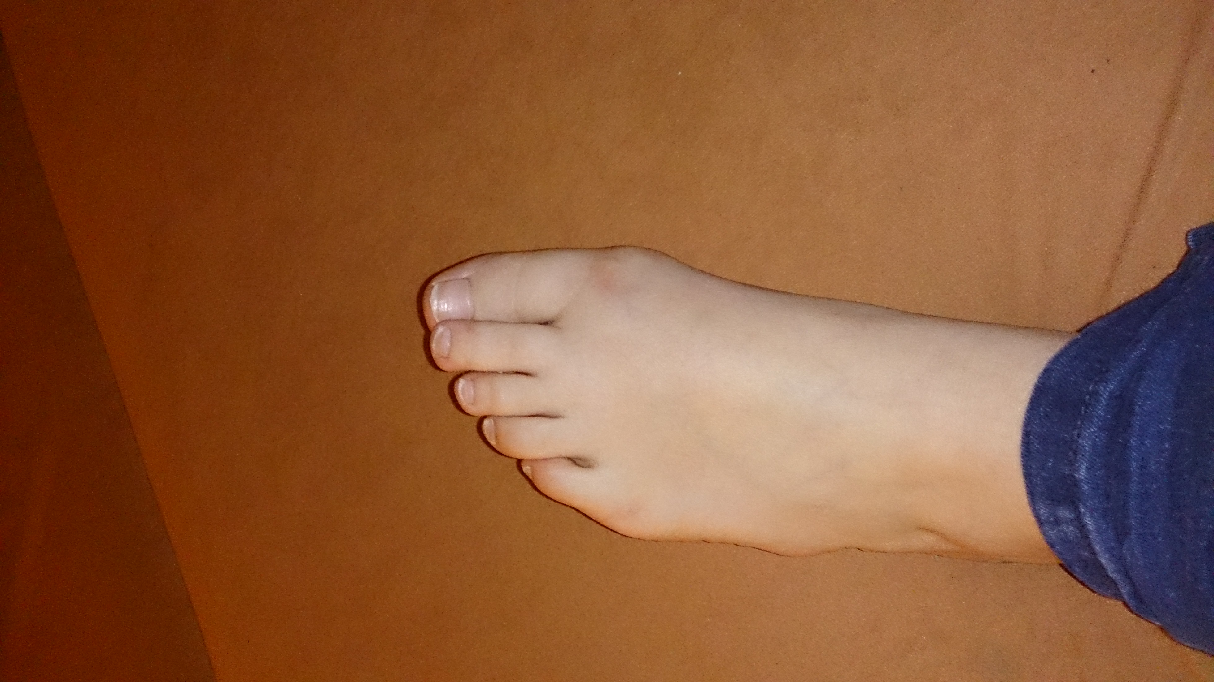 Hallux Valgus oder nicht? Brauche mal Bitte Eure Hilfe ...