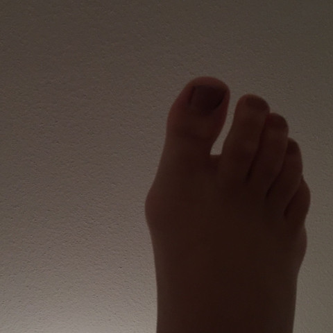 Rechter Fuß - (Füße, Orthopädie, Hallux Valgus)