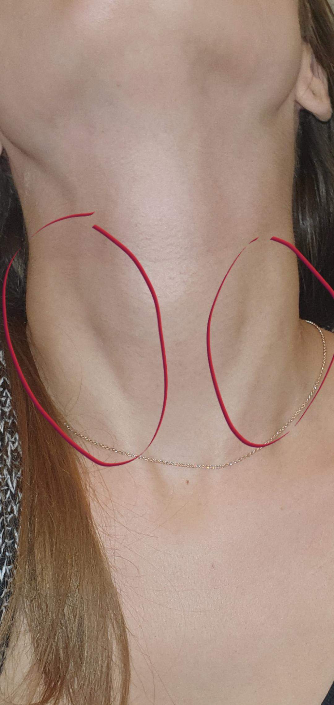 Hals geschwollen? (Gesundheit und Medizin, Halsschmerzen)