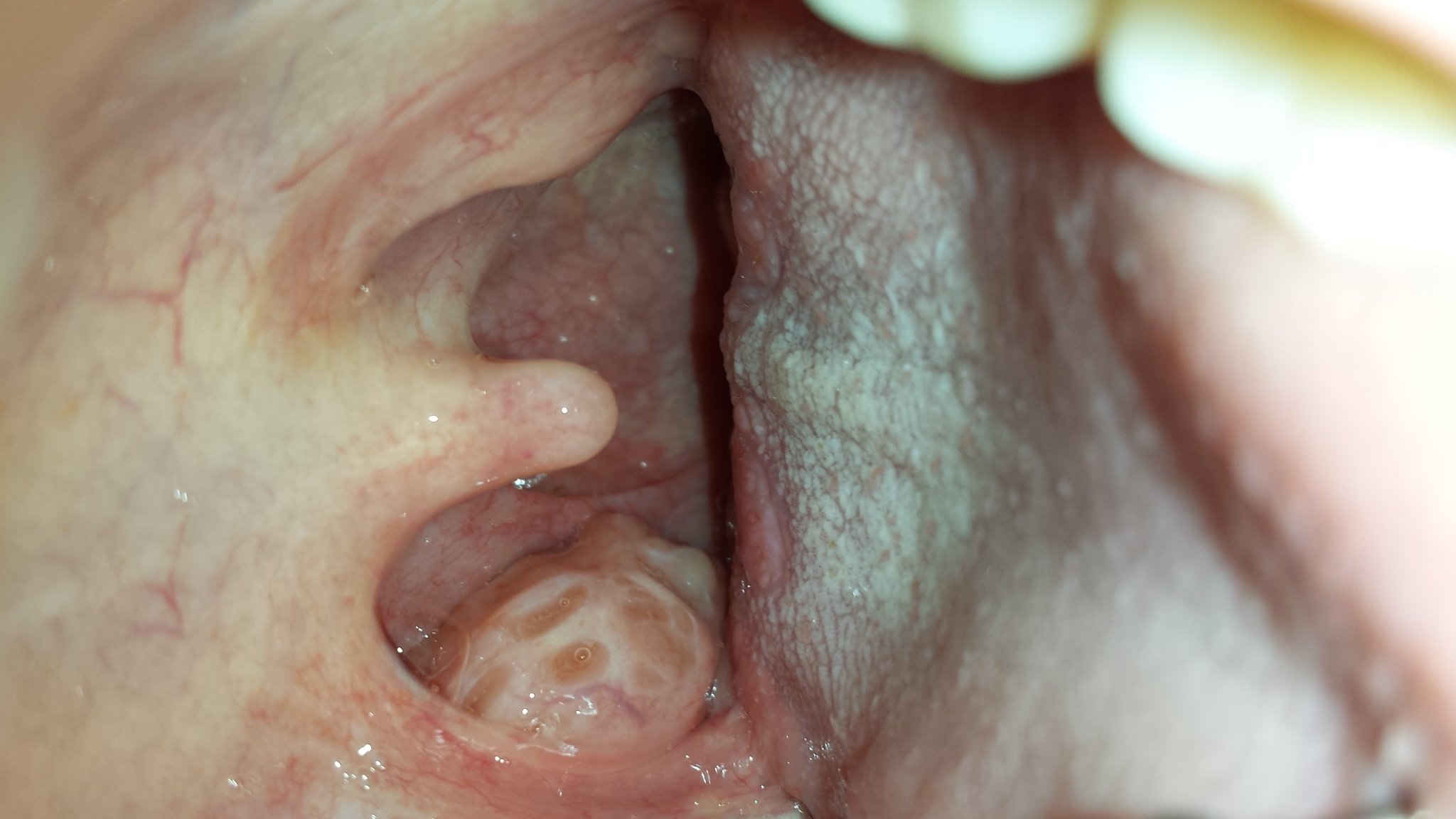 Halsschmerzen, Mandelabszess? (Gesundheit, Körper, Hals) Halsschmerzen, Mandelabszess? (Gesundheit, Körper, Hals)