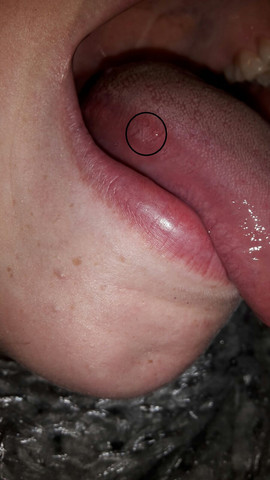 Halsschmerzen Wunde An Zungenrand Gesundheit Zunge Halsschmerzen Wunde An Zungenrand Gesundheit Zunge