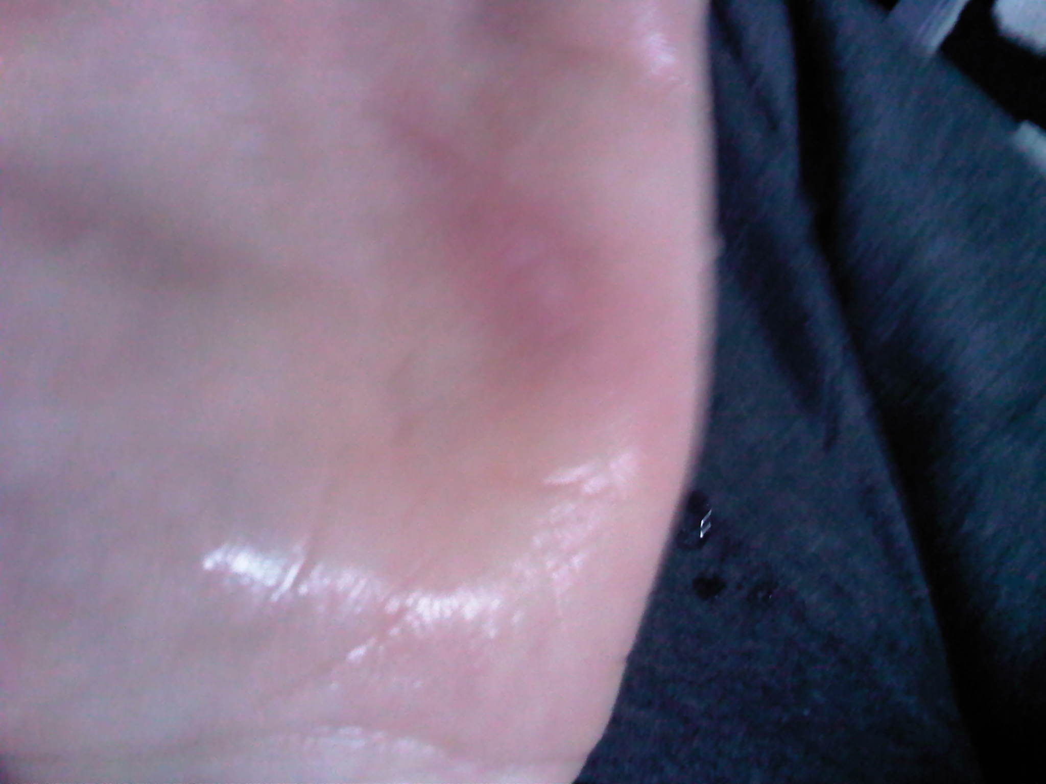 Hand am Backofen verbrannt (Gesundheit)