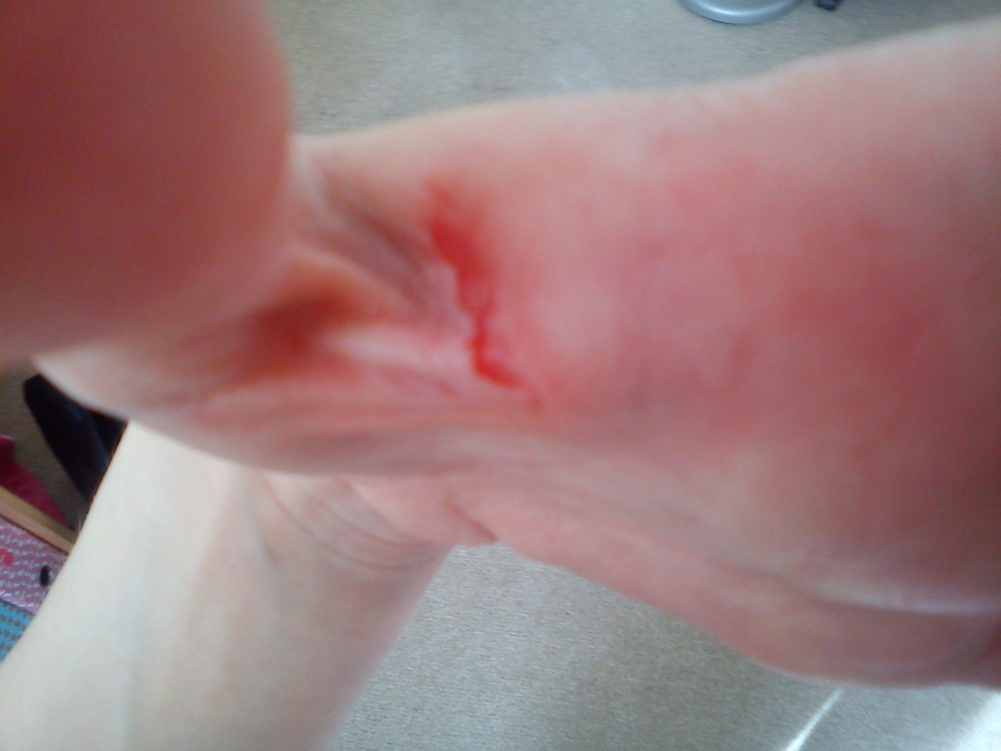 hand blutet was tun (verletzt)