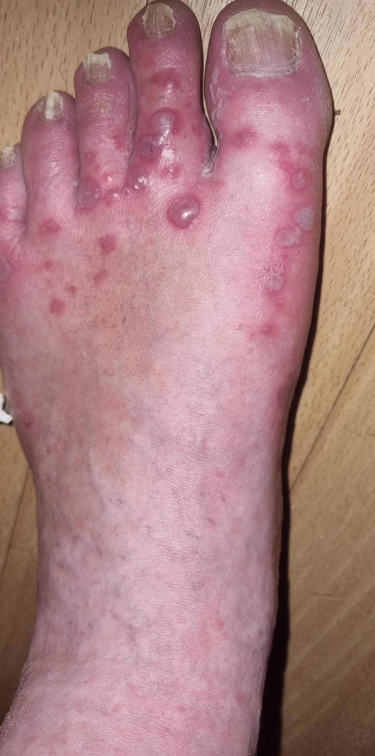 Hand Fuß Mund? (Krankheit, Schmerzen, Füße)