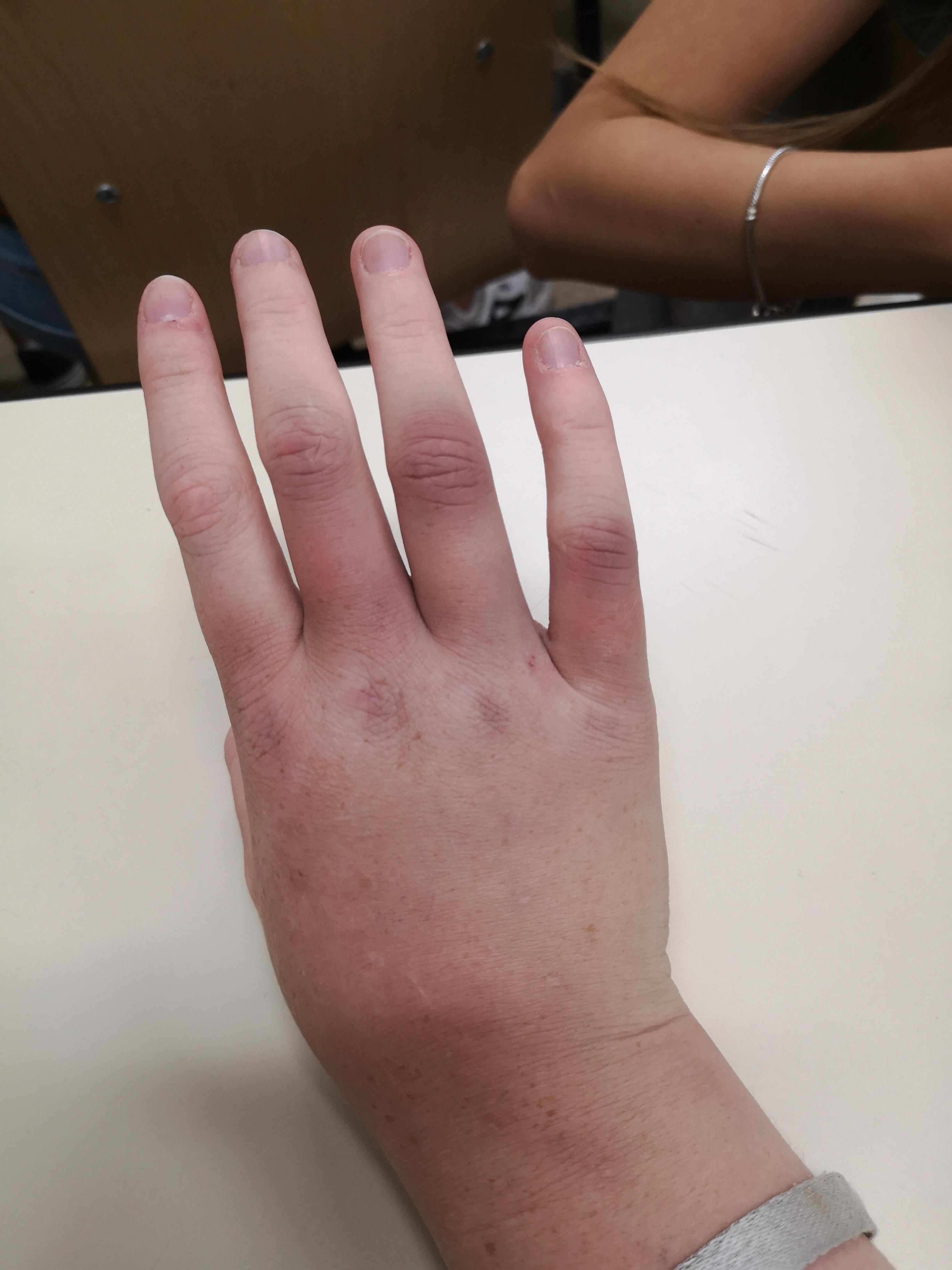 Hand Gebrochen Nach Fahrradunfall Medizin