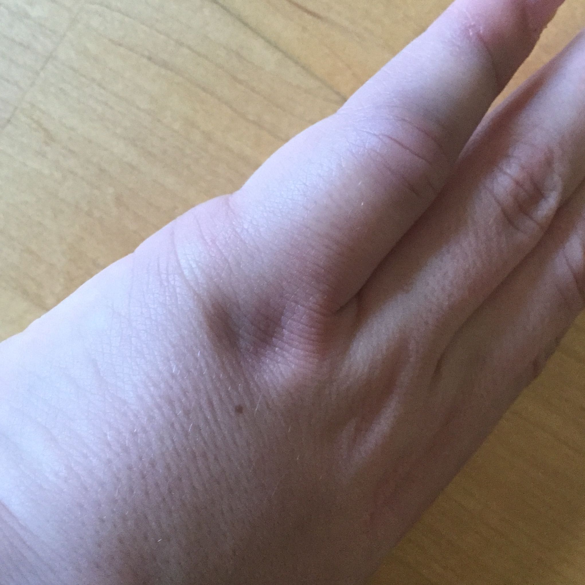 Hand gebrochen, oder Sehne gerissen? (Finger)