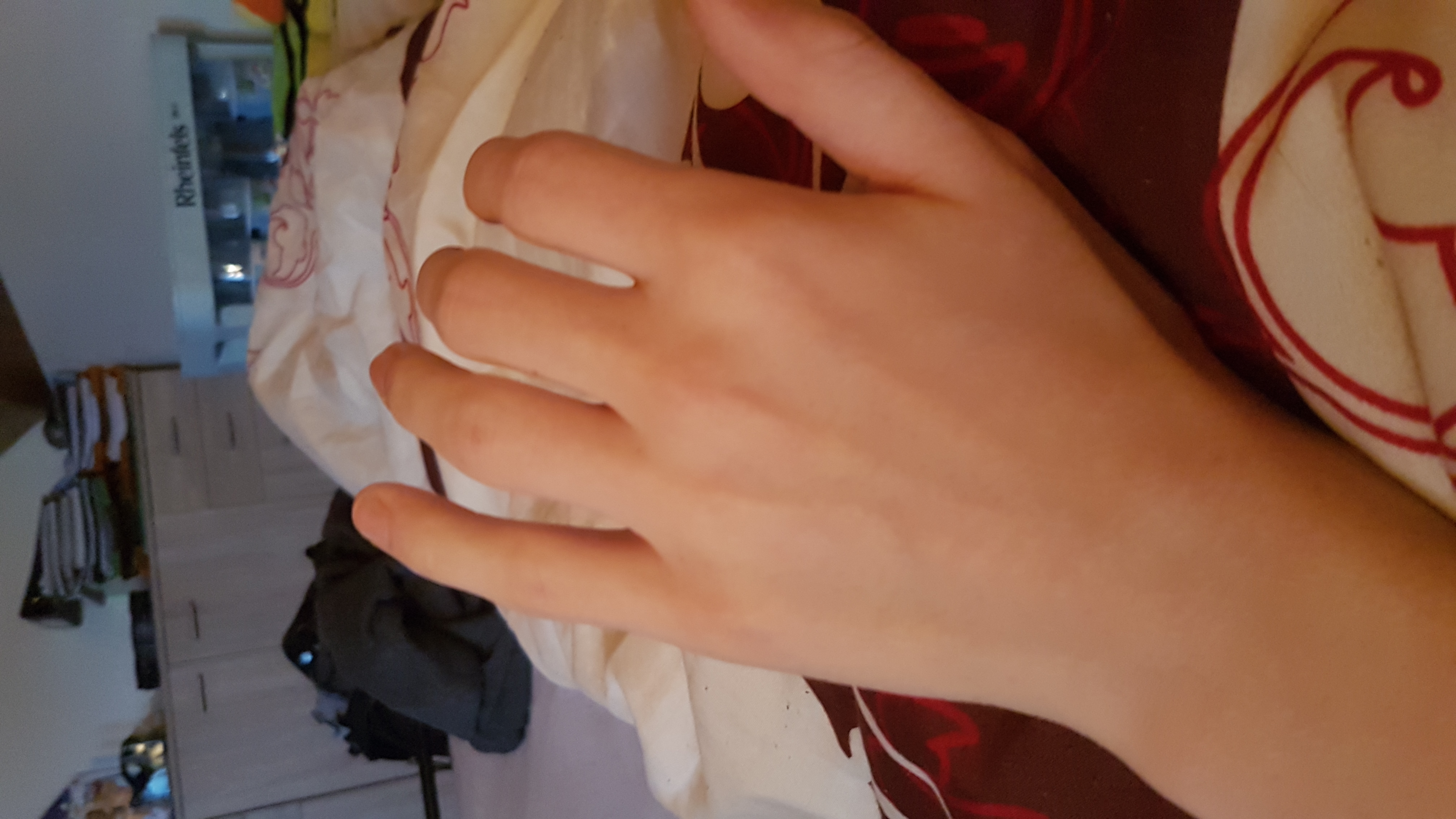 Hand gebrochen/Verstaucht/Geprellt? (Gesundheit und Medizin, Unfall)