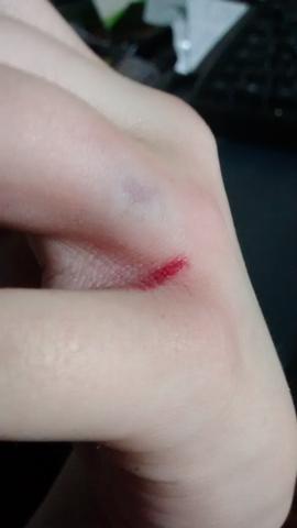 Hand gegen wand - zum Arzt? (Gesundheit, Verletzung)