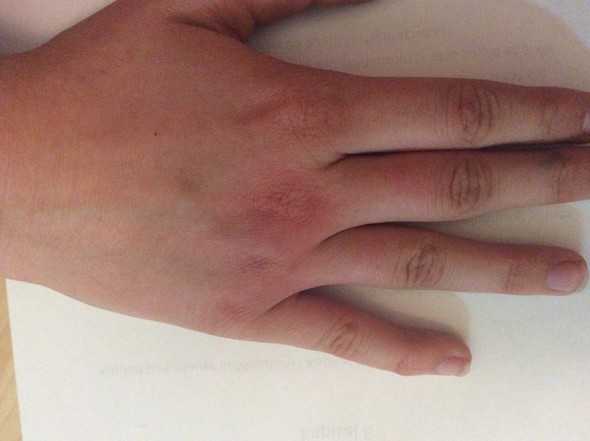 Hier meine Hand - (Verletzung, Hand)