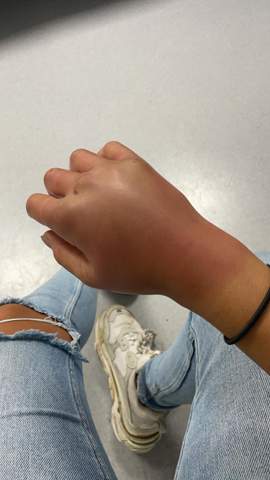 Hand geprellt oder gebrochen?