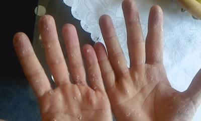 Hand Haut Fallt Ab Hand Haut Fallt Ab