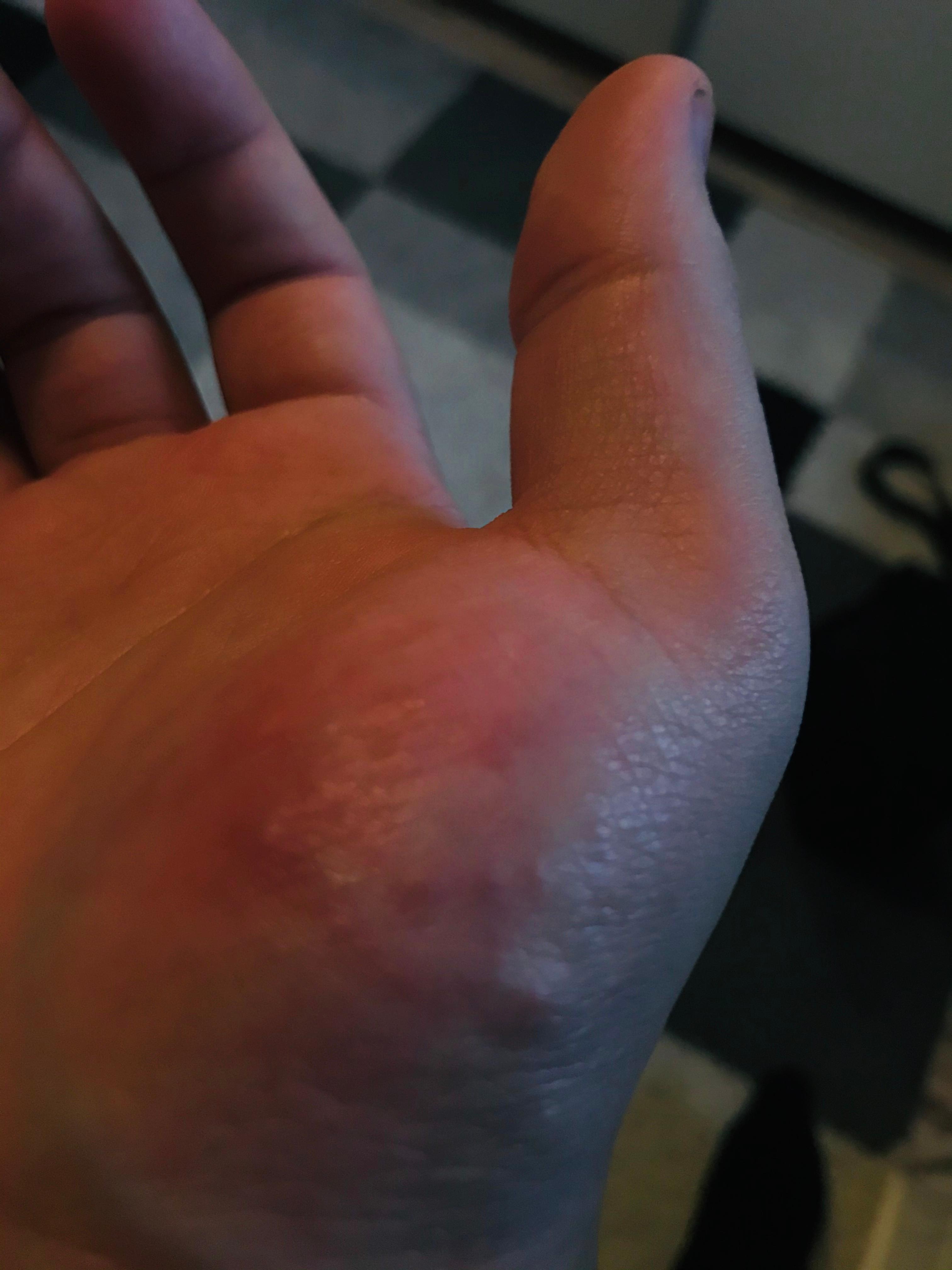 Hand kleine bläschen juckreiz? (Gesundheit und Medizin, Gesundheit)