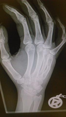 Röntgenbild - (Hand, Bruch)