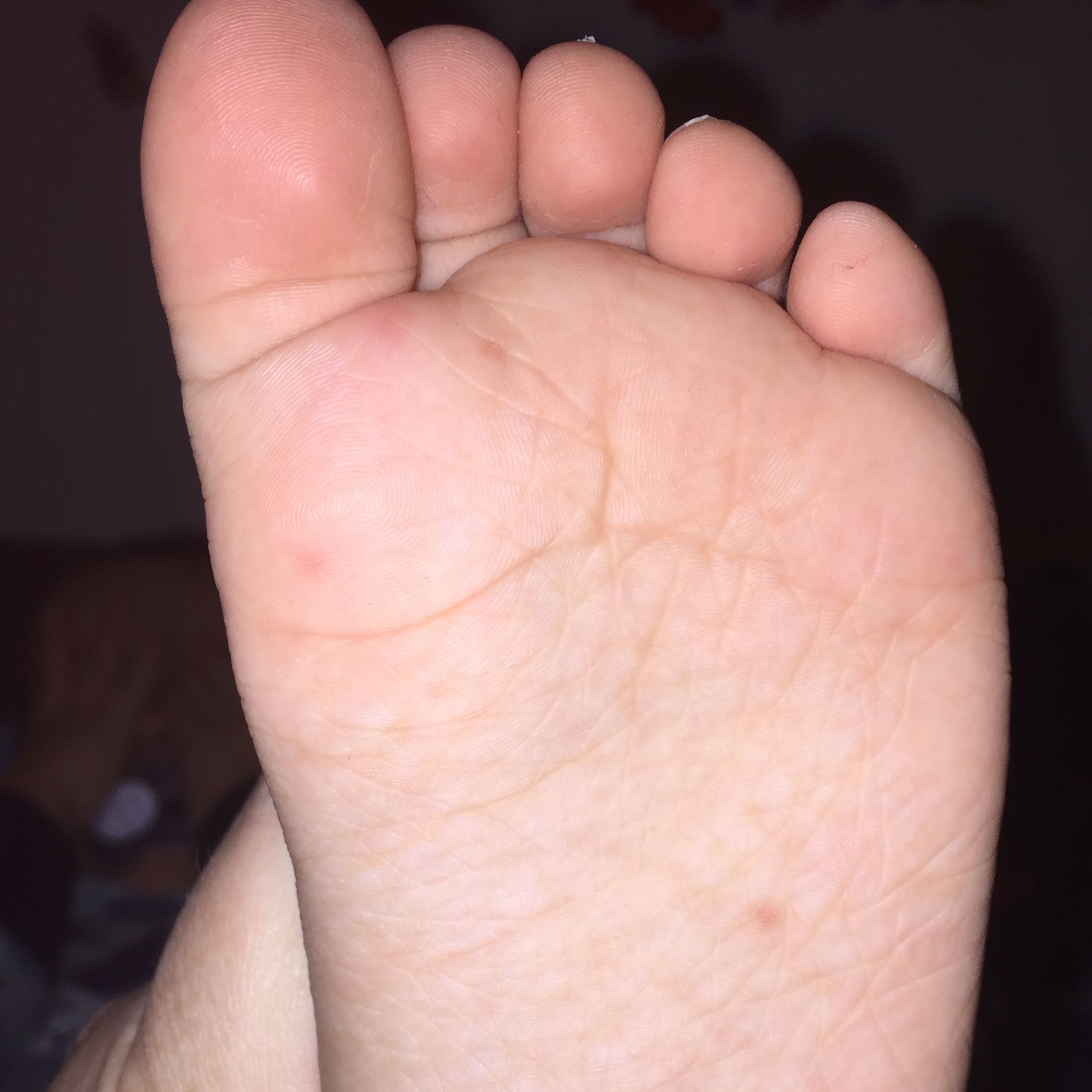 Hand Mund Fuß Krankheit Ist das die Falsche Maul und Klauenseuche Hand Mund Fuß Krankheit Ist das die Falsche Maul und Klauenseuche