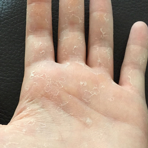 Hand Schalt Sich Vegetarier Gesundheit Und Medizin Zink Mangelerscheinung Hand Schalt Sich Vegetarier Gesundheit Und Medizin Zink Mangelerscheinung