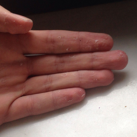 Pro finger so um die 7 - (Hand, Blase)