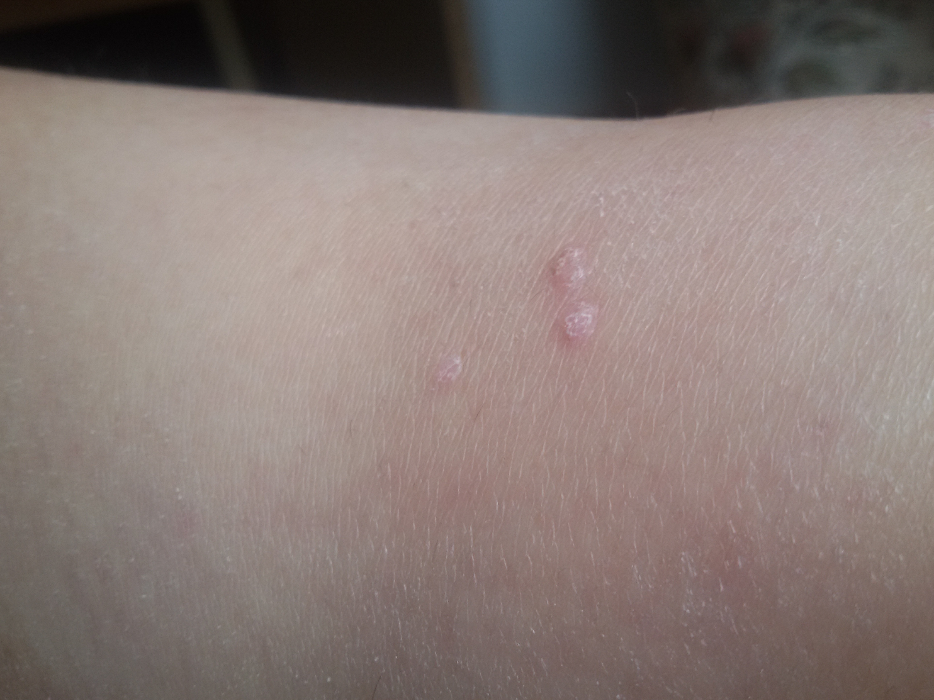 Handelt es sich hierbei um weißen Hautkrebs? (Haut, Krebs) Handelt es sich hierbei um weißen Hautkrebs? (Haut, Krebs)