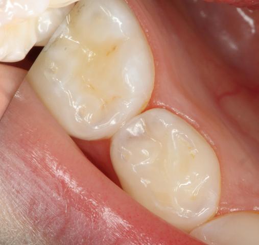 Handelt Es Sich Um Karies Gesundheit Zahnarzt Handelt Es Sich Um Karies Gesundheit Zahnarzt