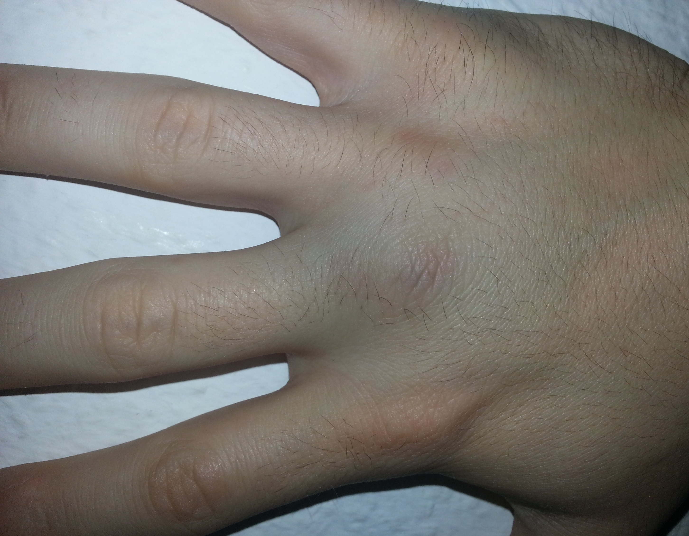 Hand/Faust verletzt?Notfall? (Verletzung)