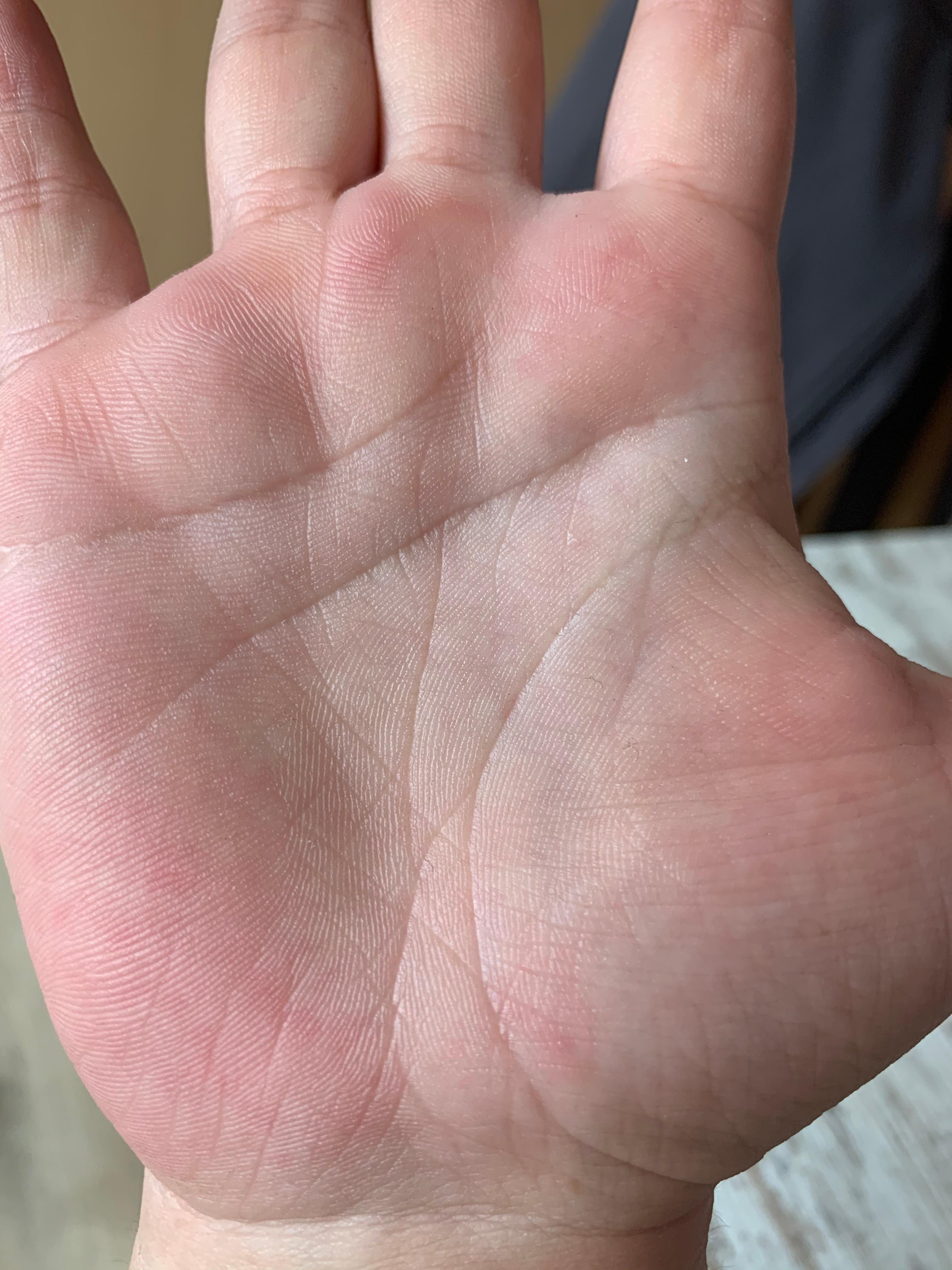 Handfläche hat rote stellen? (Haut, Hand)