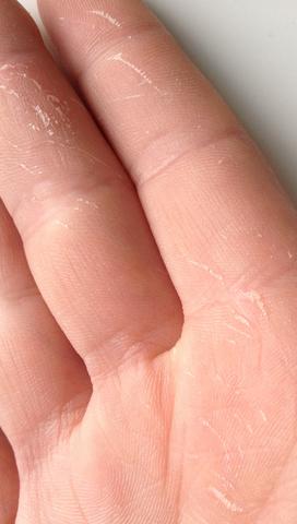 Handinnenflache Haut Pellt Sich Ab Arzt Pflege Hand Handinnenflache Haut Pellt Sich Ab Arzt Pflege Hand