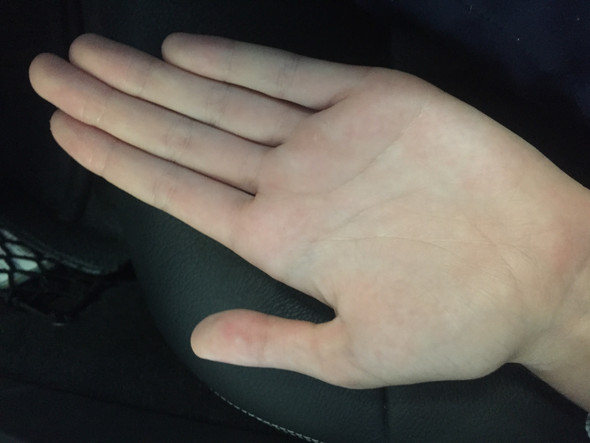 Handinnenflache Juckt Pilz Gesundheit Und Medizin Hand Pilze Handinnenflache Juckt Pilz Gesundheit Und Medizin Hand Pilze