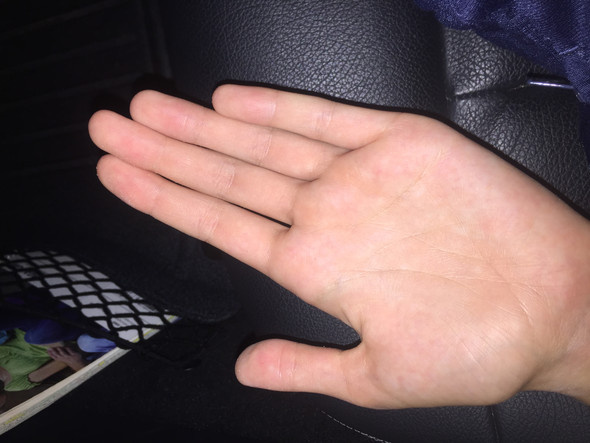 Handinnenflache Juckt Pilz Gesundheit Und Medizin Hand Pilze Handinnenflache Juckt Pilz Gesundheit Und Medizin Hand Pilze