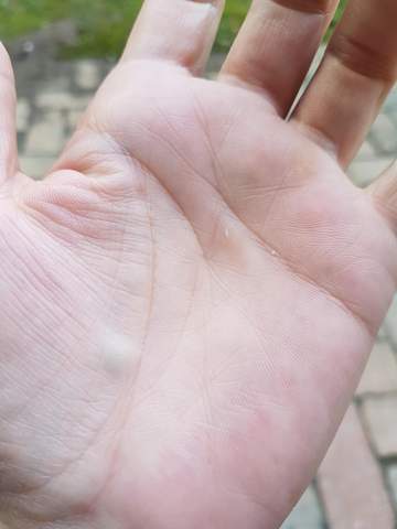 Handinnenflache Knubbel Normal Gesundheit Medizin Handinnenflache Knubbel Normal Gesundheit Medizin