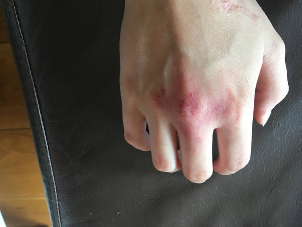 Handknochel Gebrochen Medizin