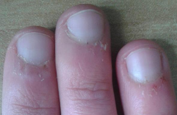 Handpflege Kaputte Haut An Fingeroberseite
