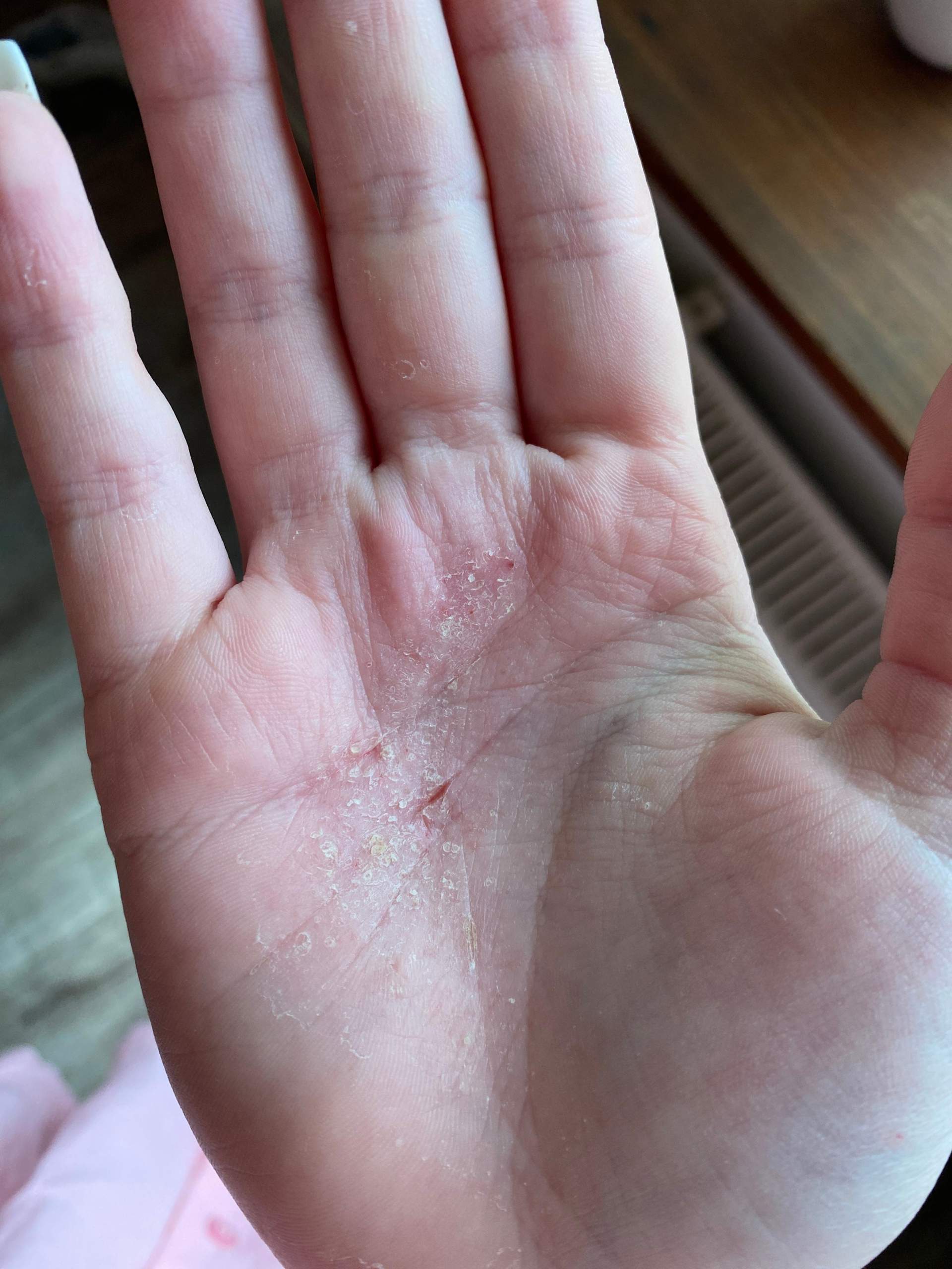Handpilz?Ekzem?Was ist das? (Gesundheit und Medizin, Haut)