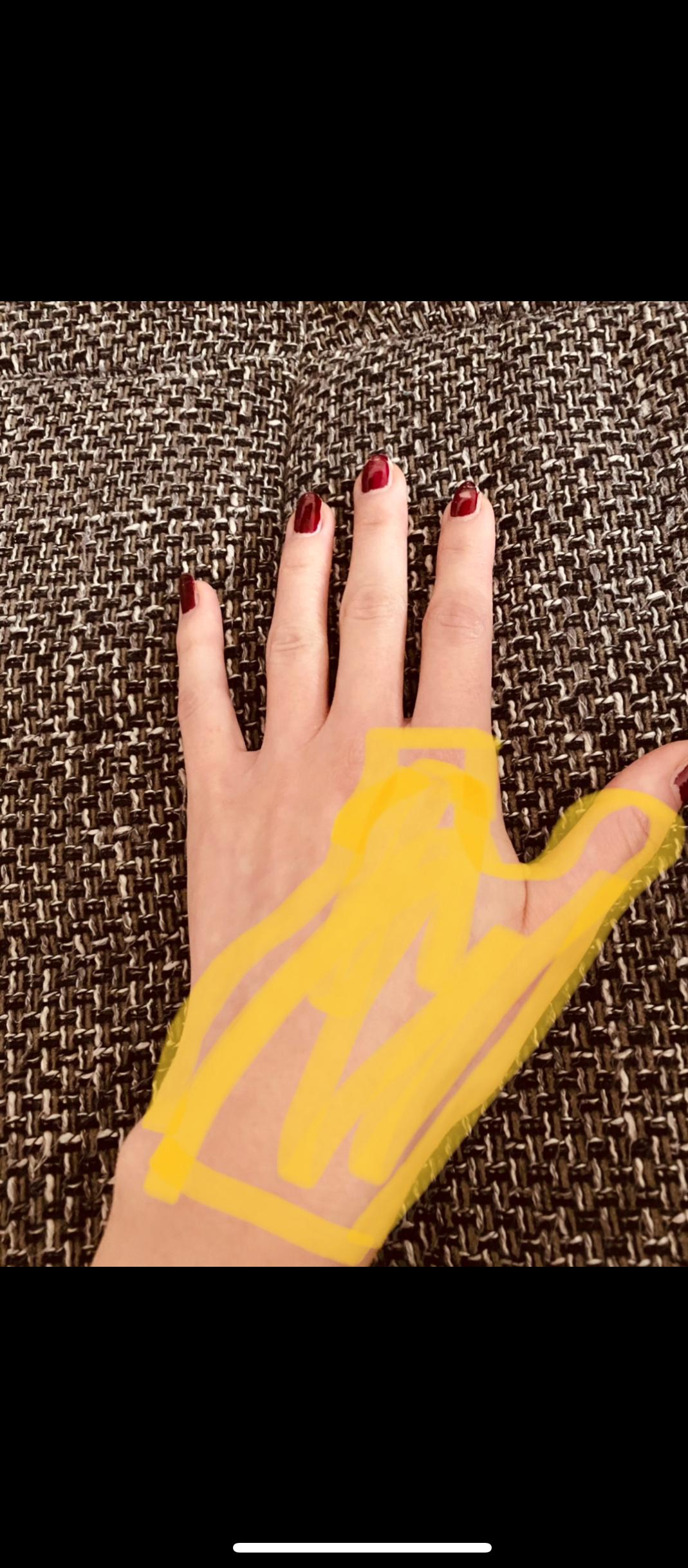 Handrücken und Daumen taub. Was könnte das sein? (Gesundheit und