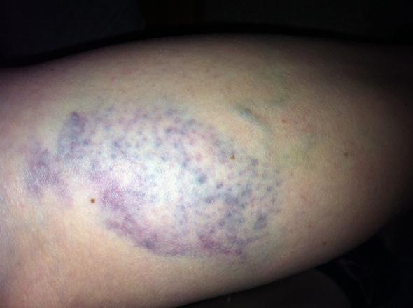 Ader Im Bein Geplatzt Blauer Fleck