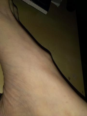 Harte Beule Auf Dem Fussrucken Gesundheit Medizin Harte Beule Auf Dem Fussrucken Gesundheit Medizin