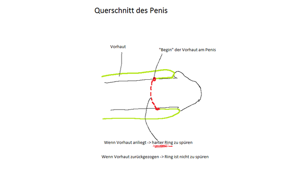 "Querschnitt" vom Penis - (Penis, Vorhaut, Vorhautverengung) .