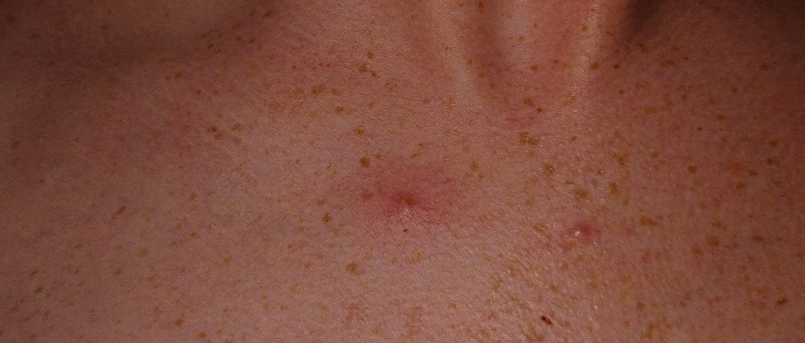 Harter schmerzhafter Pickel im DekolletĂ©? (Gesundheit und Medizin, Hautprobleme) pickel dekolleté schwangerschaft