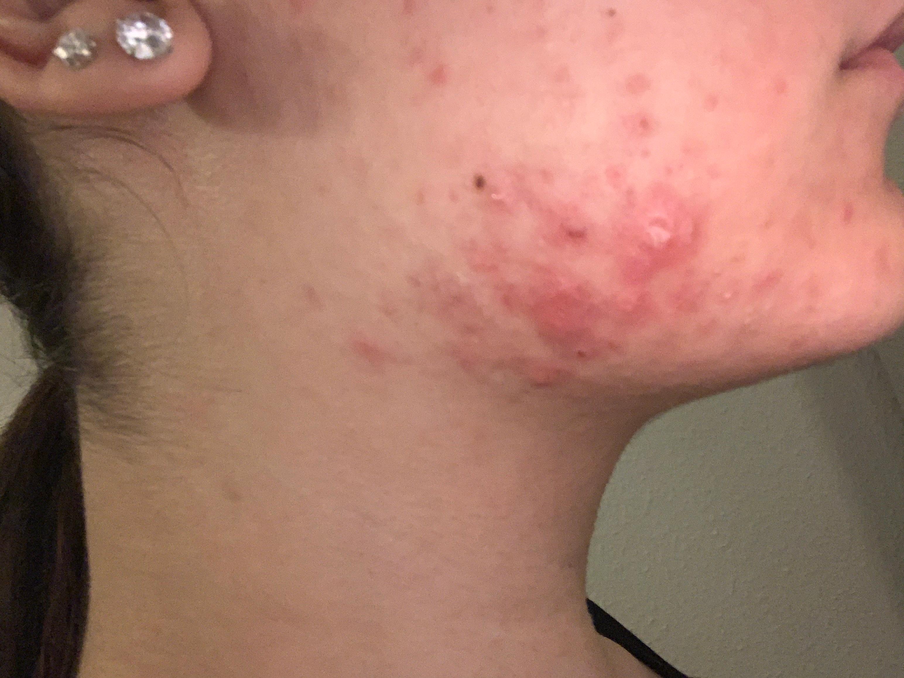 Hartnackige Pickel Loswerden Haut