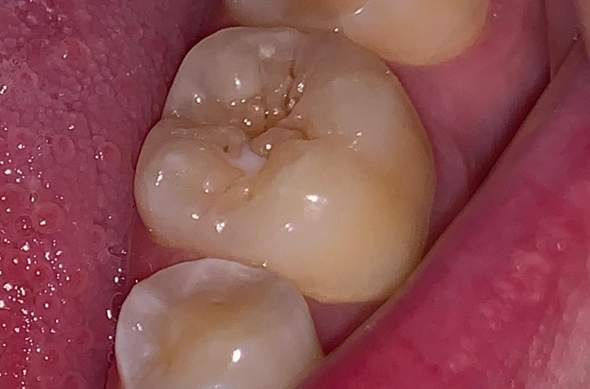 Hat Dieser Zahn Initial Karies Zahne Hat Dieser Zahn Initial Karies Zahne