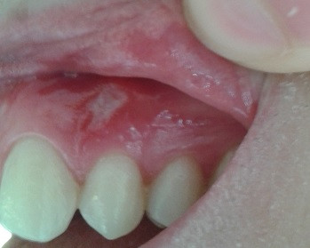 Über dem mittleren Zahn - (Entzündung, Mund, aphten)