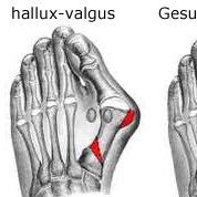 Hallux valgus  - (Schmerzen, Füße, tanzen)
