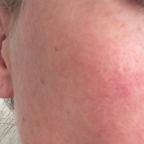 Süd Archäologe MorseCode spritze bei sonnenallergie Kann Mitwirkender Drucken