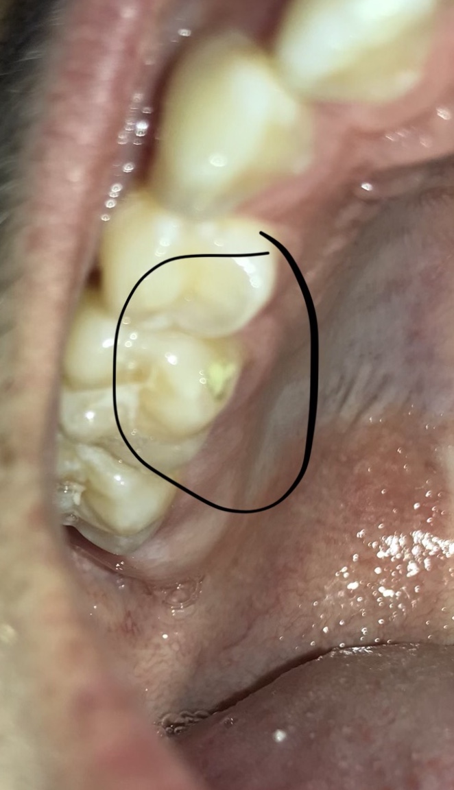 Hat mein Backenzahn Karies? (Zahnspange) Hat mein Backenzahn Karies? (Zahnspange)