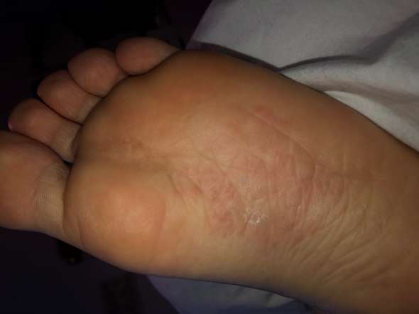 Hat Mein Freund Fusspilz Gesundheit Fusse Pilze Hat Mein Freund Fusspilz Gesundheit Fusse Pilze