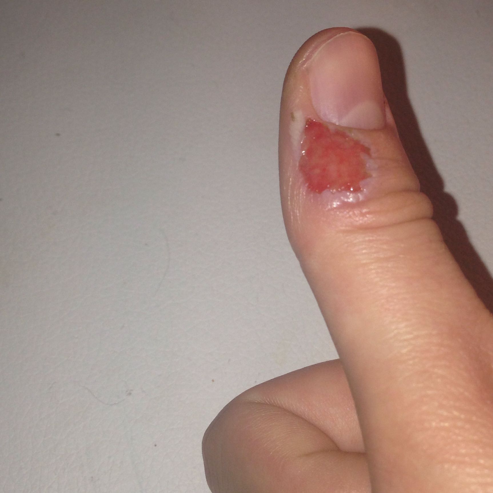 Hat sich diese offene Wunde entzündet und was hilft dagegen? (Gesundheit, Haut, Entzündung) Hat sich diese offene Wunde entzündet und was hilft dagegen? (Gesundheit, Haut, Entzündung)