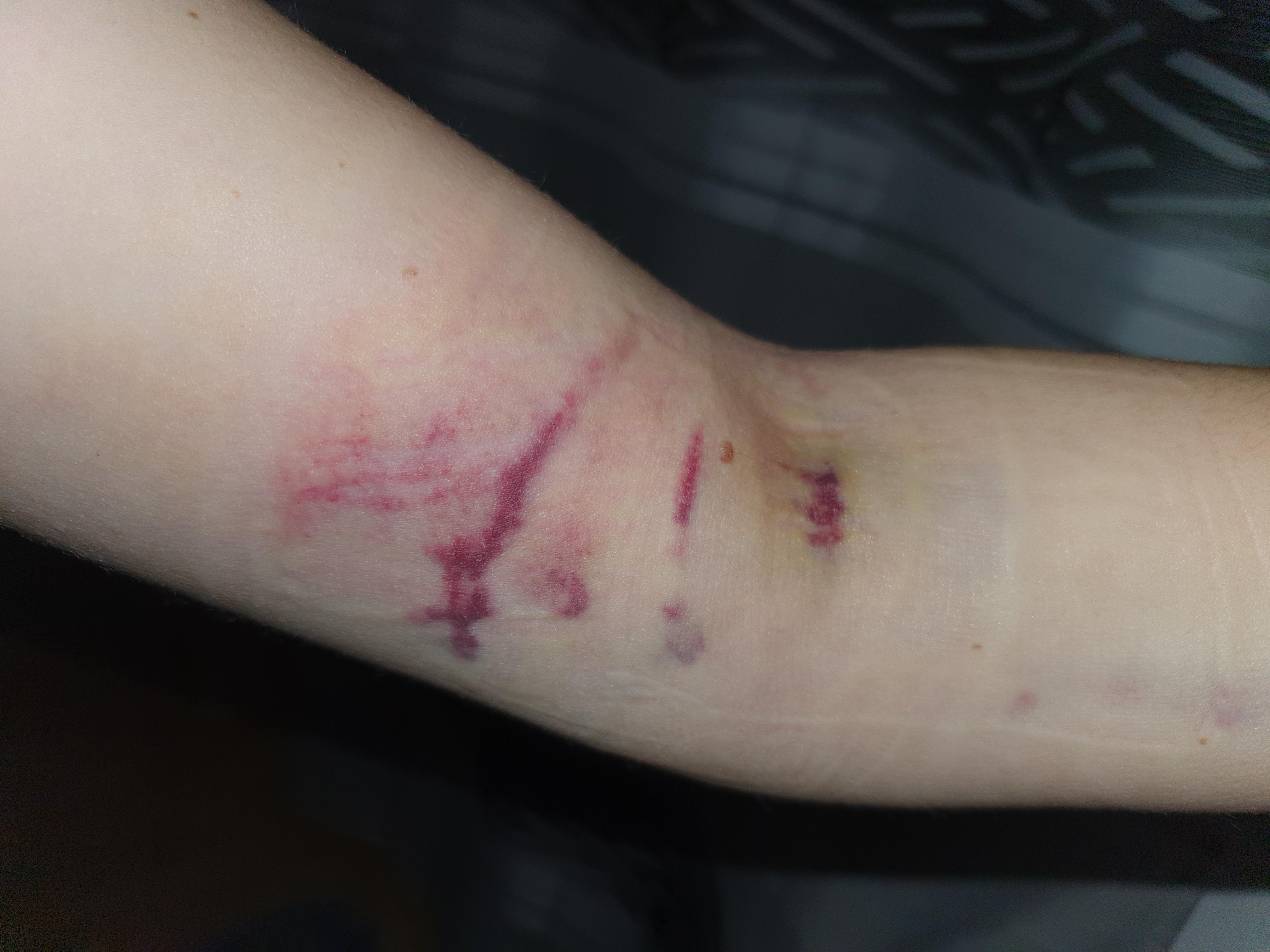 Hatte Das Schon Jemand Nach Einer Blutabnahme Bitte Um Antworten Gesundheit Und Medizin Gesundheit Hatte Das Schon Jemand Nach Einer Blutabnahme Bitte Um Antworten Gesundheit Und Medizin Gesundheit