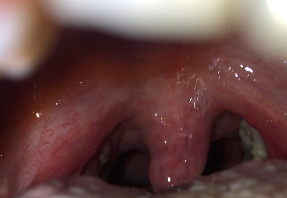 Hatte Das Schonmal Jemand Weisser Belag Mandeln Gesundheit Und Medizin Freizeit Hatte Das Schonmal Jemand Weisser Belag Mandeln Gesundheit Und Medizin Freizeit