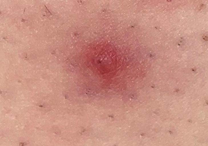 Hatte etwas Pickelartiges auf dem Oberschenkel, habe es nicht angerührt und nach paar Tagen pickel auf dem oberschenkel